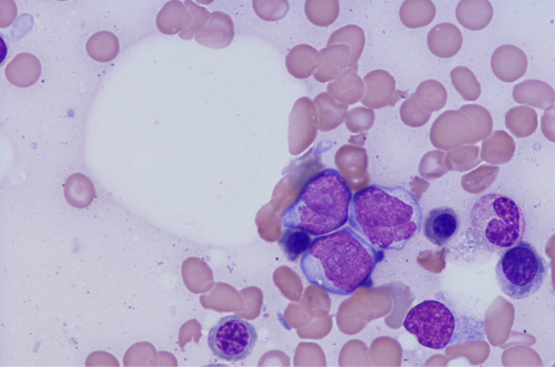 Acute myeloid leukemia (AML) cells